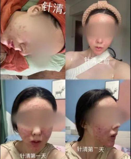 广西20岁美女祛痘不成反“烂脸”要索赔！美容院：放弃治疗后果自负