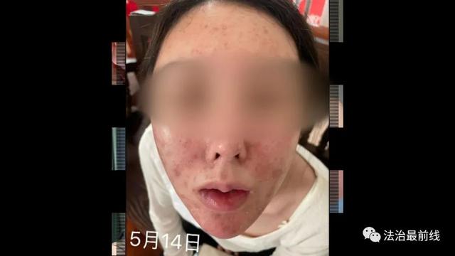 广西20岁美女祛痘不成反“烂脸”要索赔！美容院：放弃治疗后果自负